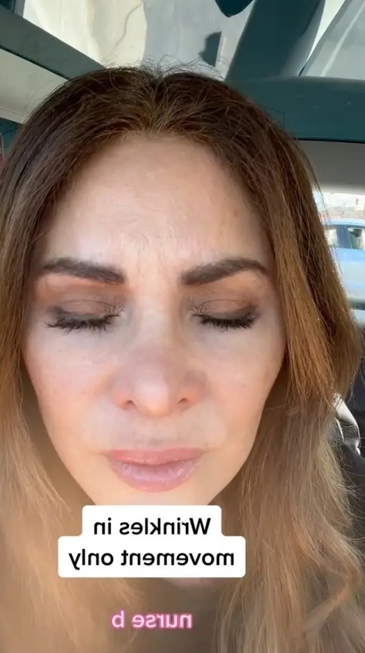Η νοσοκόμα της Καλιφόρνιας μοιράζεται πώς φαίνεται το πρόσωπό της μετά τη διακοπή των ενέσεων Botox