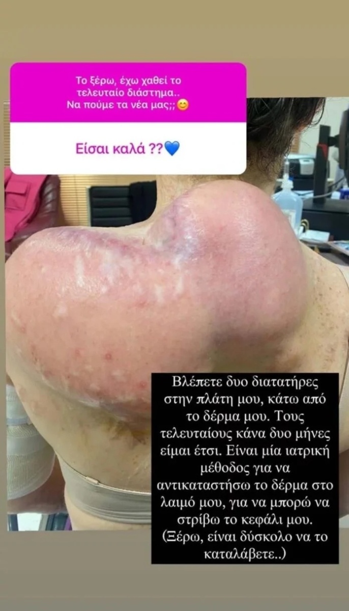 Η σοκαριστική ανάρτηση της Ιωάννας Παλιοσπύρου στο Instagram αποκαλύπτει τον δρόμο της προς την ανάρρωση