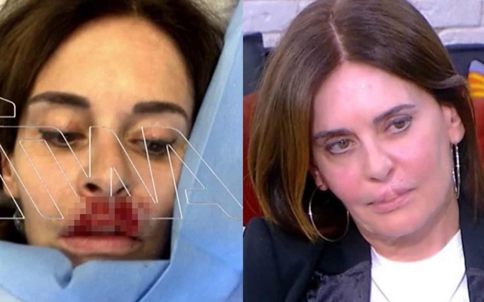 Ο εφιάλτης της Κατερίνας Πλουμιδάκη: Έλληνας πλαστικός χειρουργός καταστρέφει τα χείλη συγγραφέα>