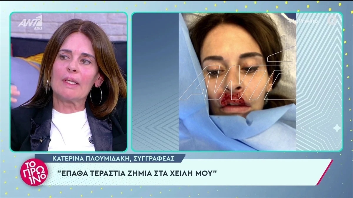 Ο εφιάλτης της Κατερίνας Πλουμιδάκη: Έλληνας πλαστικός χειρουργός καταστρέφει τα χείλη συγγραφέα