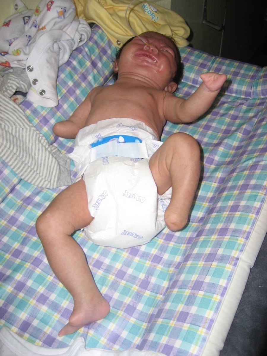 Οικογένεια υιοθετεί παιδί που γεννήθηκε χωρίς άκρα, μύτη και στόμα
