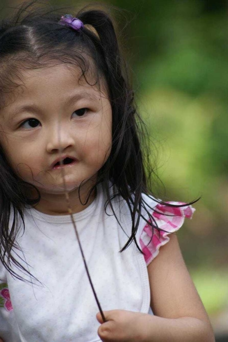 Οικογένεια υιοθετεί παιδί που γεννήθηκε χωρίς άκρα, μύτη και στόμα