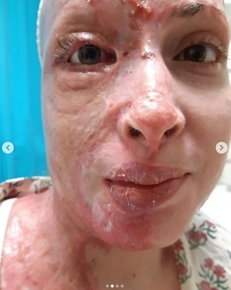 Η ανθεκτικότητα της Ιωάννας Παλιοσπύρου: Φωτογραφίες από το ταξίδι της μετά την επίθεση Βιτριόλης