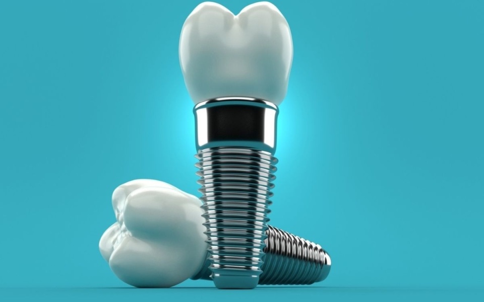 Μέθοδος All-on-4®: Δόντια την ίδια μέρα με οδοντικά εμφυτεύματα>